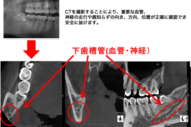 親知らずの抜歯で・・・