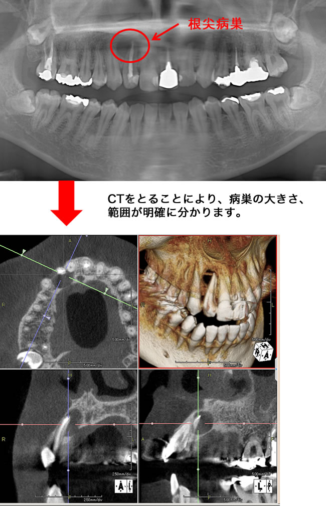 根管治療（根の治療）で・・・