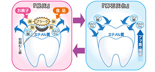 むし歯の進行