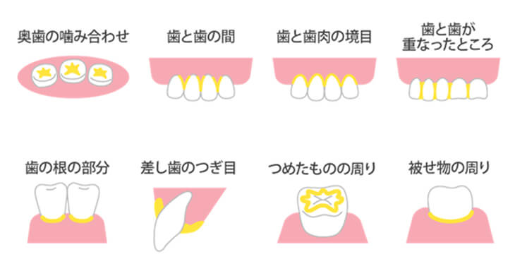 むし歯になりやすいところ