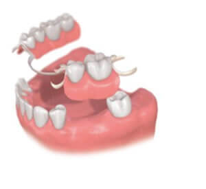従来の治療方法 部分入れ歯