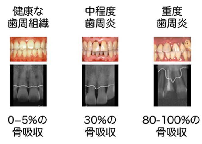 歯周ポケットの測