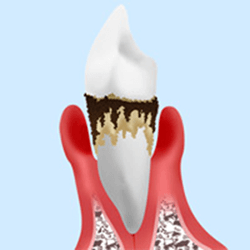 重度の歯周病