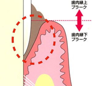 縁下プラーク（歯垢）