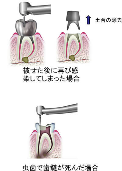 切削器具によりむし歯や被せ物の除去