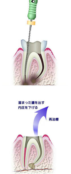 根管治療 – 大和 歯医者/歯科｜今宮歯科医院 大和駅徒歩3分
